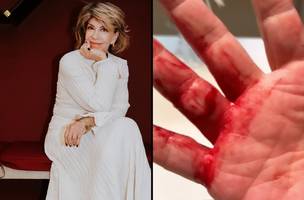 A apresentadora compartilhou nas redes sua mão ferida após o incidente (Foto: Reprodução)
