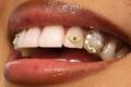 Grillz e Piercings prejudicam os dentes? Especialista alerta sobre tendência
