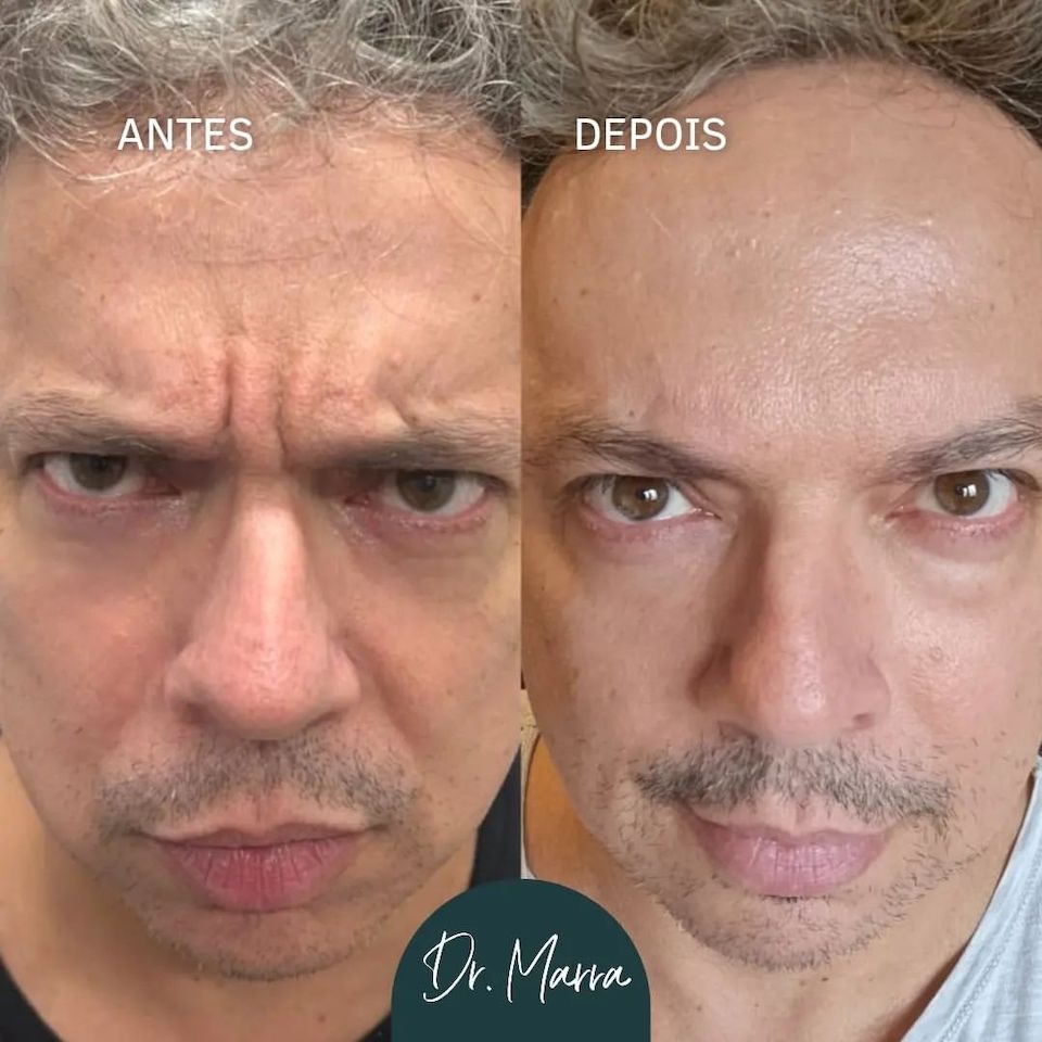 Botox