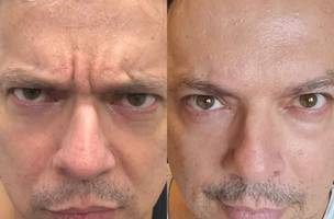 Botox (Foto: Divulgação)