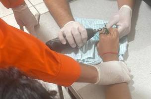 O dedo da criança já estava preto (Foto: Divulgação)