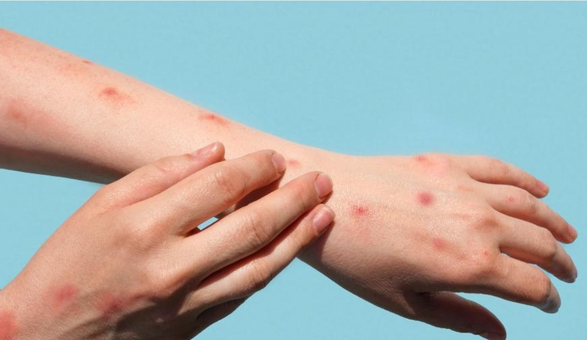 Sesapi confirma mais dois novos casos de Monkeypox