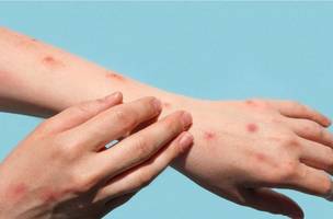 Sesapi confirma mais dois novos casos de Monkeypox (Foto: iStock)