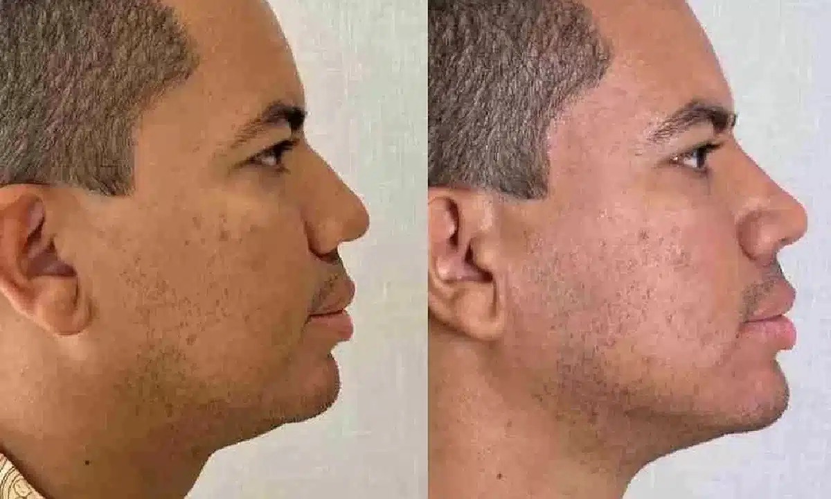 IInfluencer Bruno Diferente faz harmonização facial; veja resultado