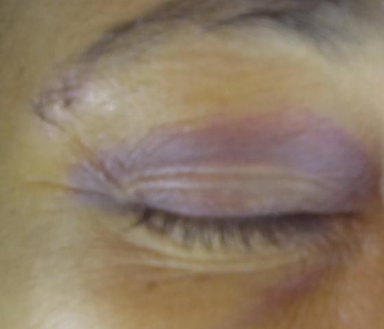 Técnica em enfermagem é agredida com soco no rosto por paciente no Lineu Araújo