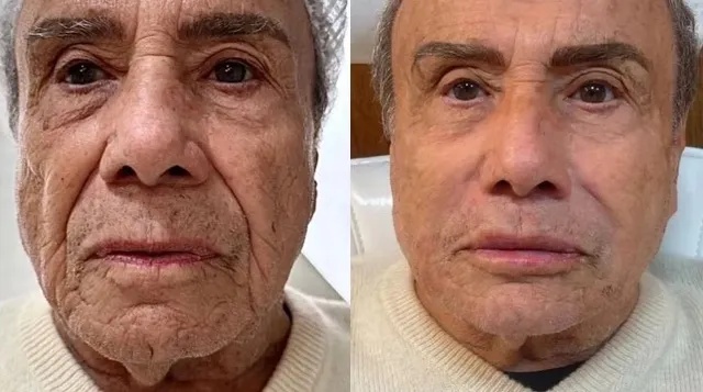 Antes e depois dos procedimentos estéticos de Stenio Garcia