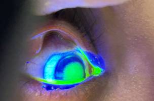 Lesões oculares causadas por pomada capilar (Foto: PMT)