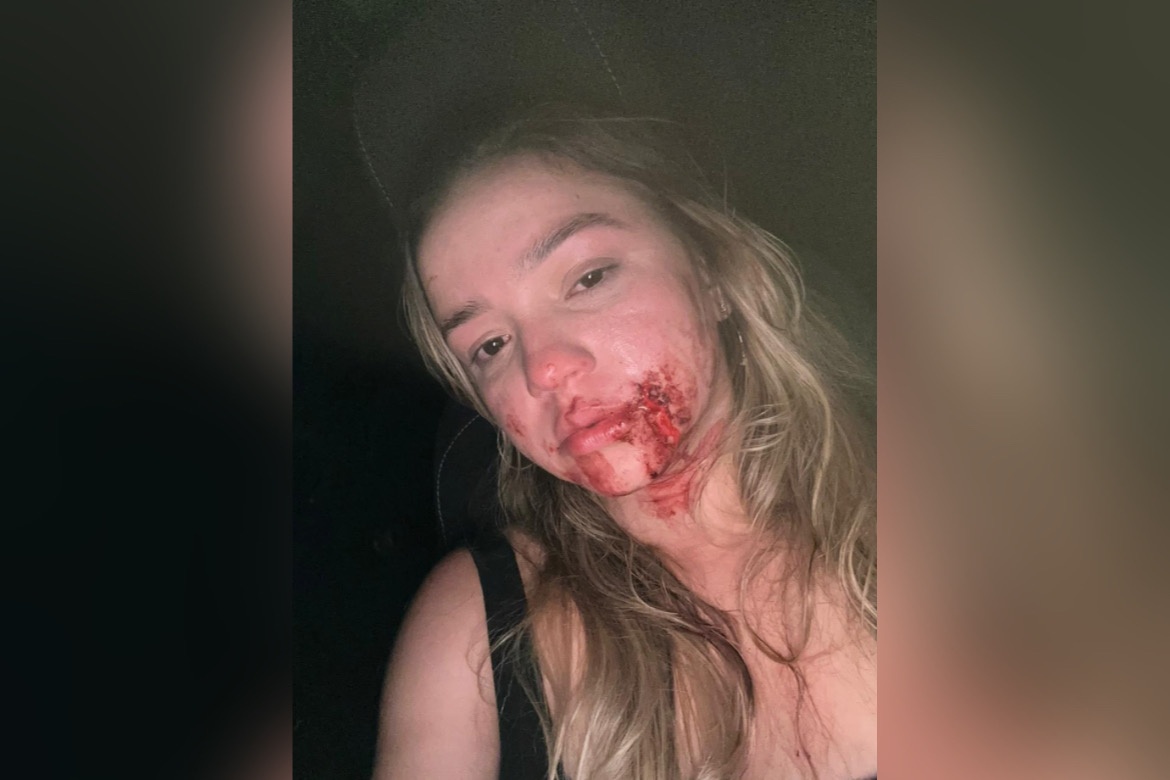 Mariana sofreu cortes na boca por conta da agressão sofrida