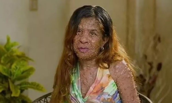 Charmaine Sahadeo, livre de boa parte dos tumores, e cujo caso foi retratado pela TLC.