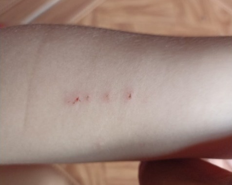 Marcas no braço da criança