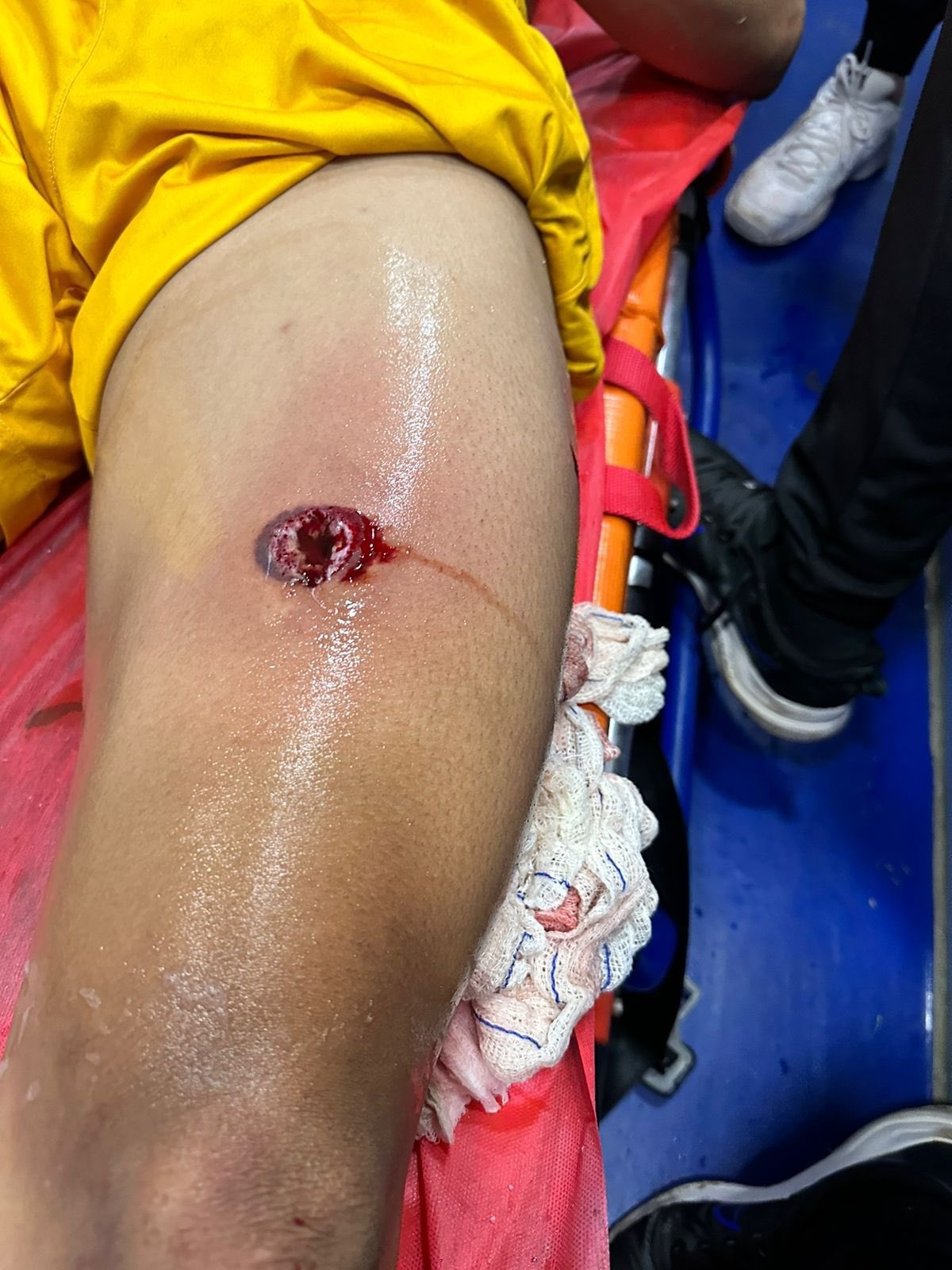 Ferimento na coxa do goleiro