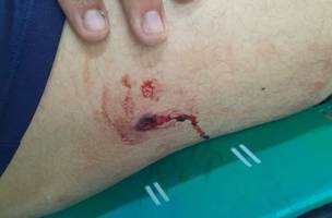 Mulher baleada em ocupação (Foto: Reprodução)