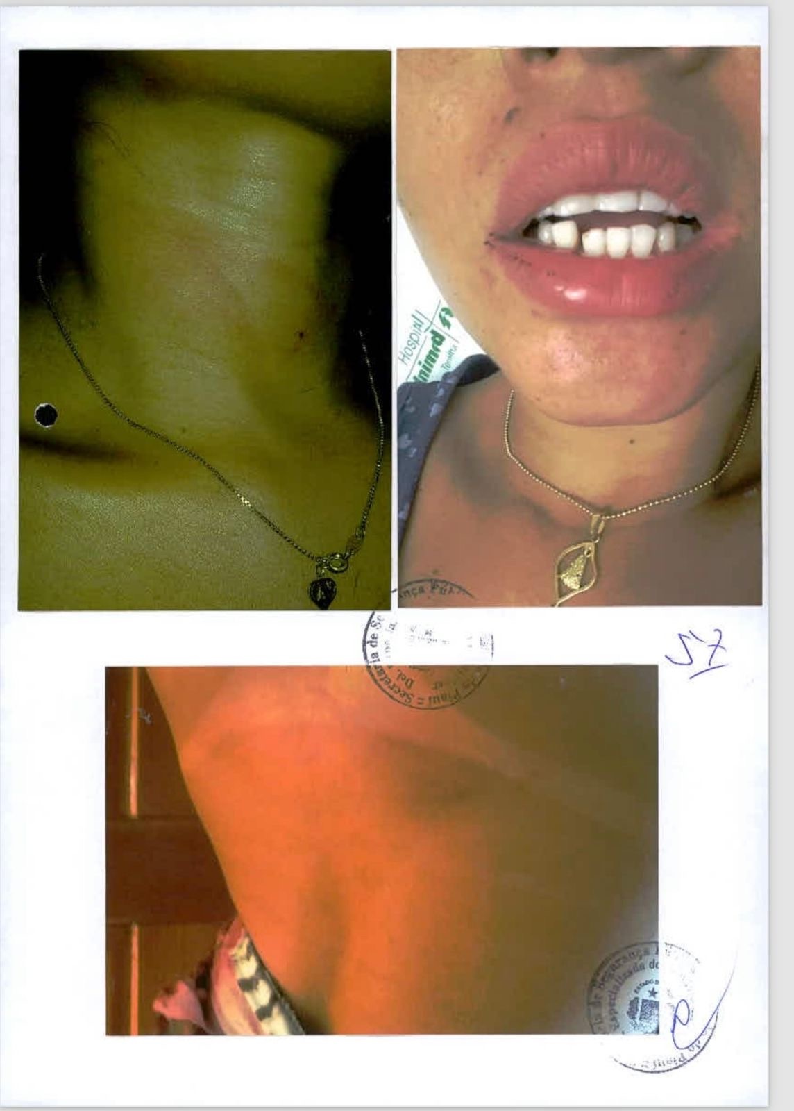 A mulher teve dois dentes quebrados e ficou com diversas marcas das agressões