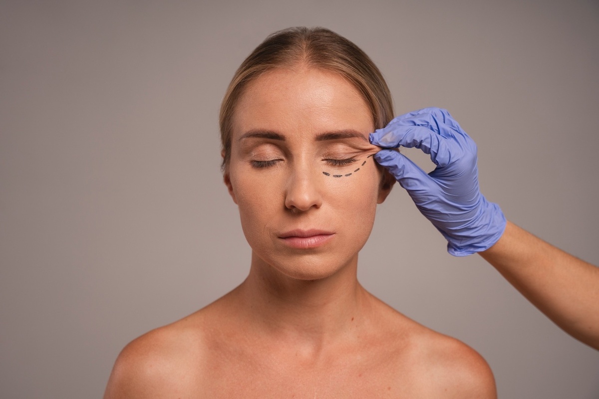 blefaroplastia