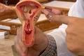 Endometriose: SUS inclui novos tratamentos hormonais