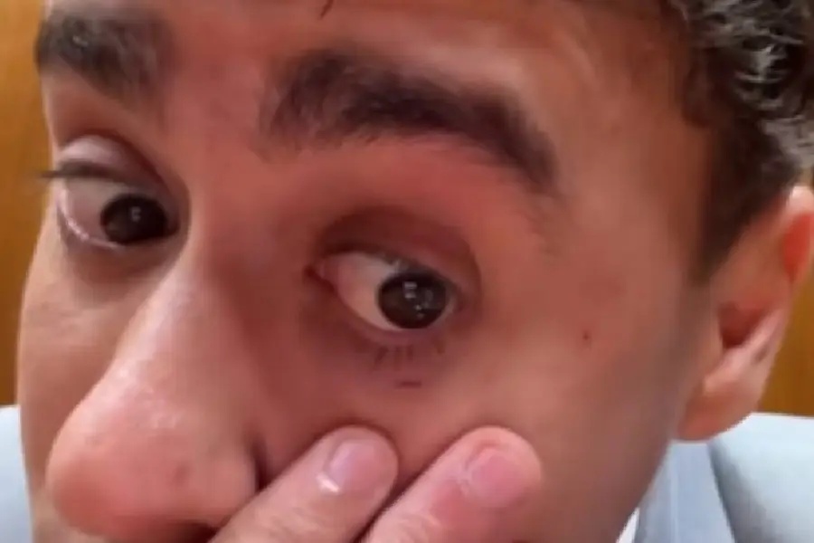 Nikolas Ferreira exibe corte abaixo do olho sofrido durante confusão com visita de Bolsonaro à Câmara