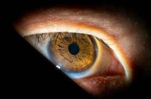 Nova técnica poderá tratar glaucoma e catarata em um único procedimento pelo SUS. (Foto: Reprodução)