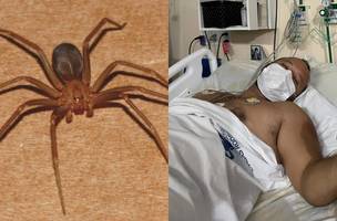 Enfermeiro picado por aranha-marrom recebe alta depois de ser internado em UTI no Piauí (Foto: -)
